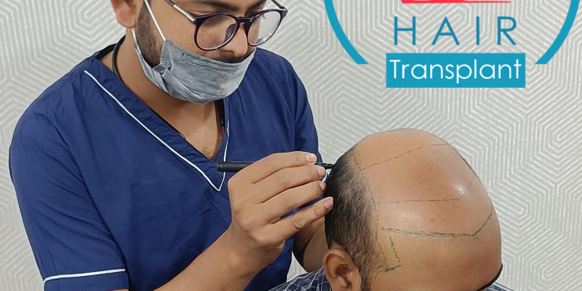 Hair Transplant in Agra | Hair Transplant in Indore | Hair Transplant in India | RMD Hair Transplant