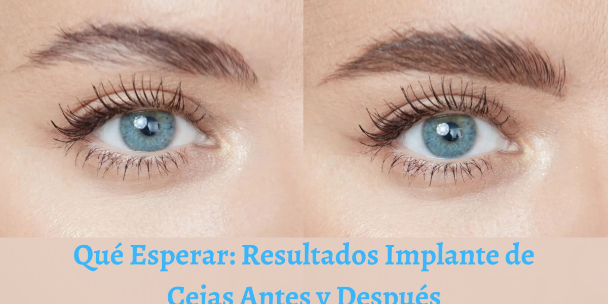 Qué Esperar: Resultados Implante de Cejas Antes y Después